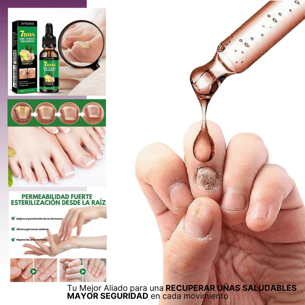 7 Days Fungus Free Nails® | Protege y elimina el hongo de tus Uñas en tan solo 7 días